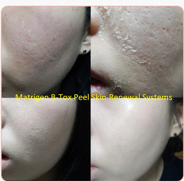 Matrigen B-TOX Peel Treatment Professional